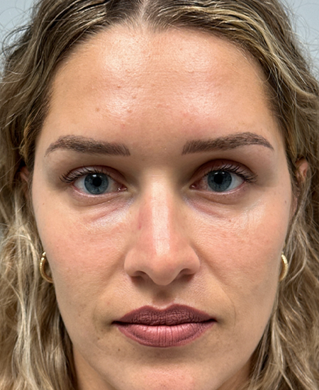 BY BONNIE patient 16 before dissolving under eye filler.png