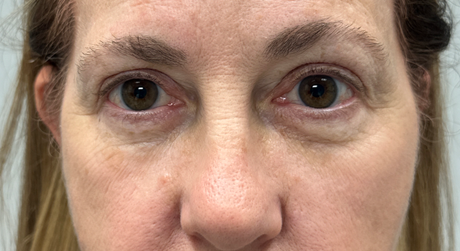 BY BONNIE patient 17 after dissolving under eye filler.png