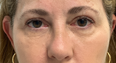 BY BONNIE patient 17 before dissolving under eye filler.png