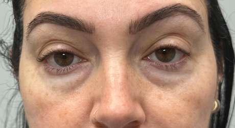 BY BONNIE patient 18 after dissolving under eye filler.png