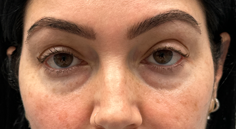 BY BONNIE patient 18 before dissolving under eye filler.png