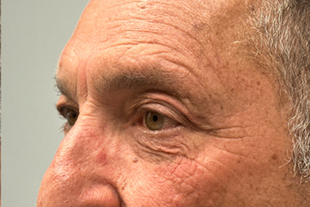 PATIENT 5 SIDE BY SIDE.jpg