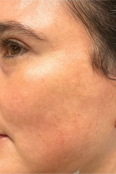 Patient 1 before PRP with microneelding.PNG