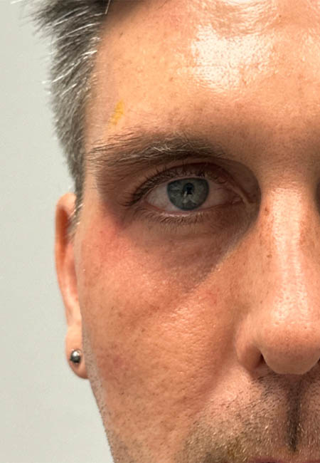 Untitled-1_0001_patient 10 after cheek filler.png