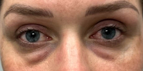 a_0006_patient 58 before lower bleph with facial fat grafting- front.png