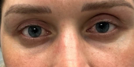 a_0007_patient 58 after lower bleph with facial fat grafting- front.png