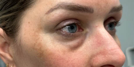 a_0008_patient 58 before lower bleph with facial fat grafting- side.png
