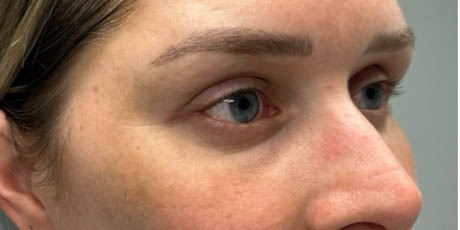 a_0009_patient 58 after lower bleph with facial fat grafting- side.png