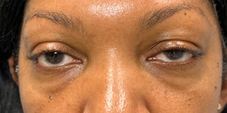 a_0010_pt before 59 lower bleph with facial fat grafting- front.png