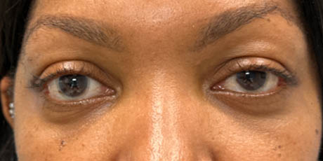 a_0011_pt after 59 lower bleph with facial fat grafting- front.png