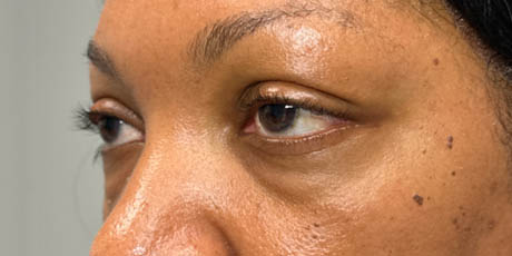 a_0012_pt 59 before lower bleph with facial fat grafting- left side.png