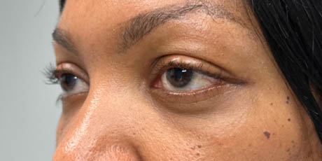 a_0013_pt after 59 lower bleph with facial fat grafting- left side.png
