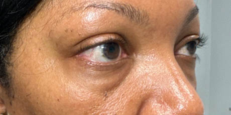a_0014_pt before 59 lower bleph with facial fat grafting- right side.png