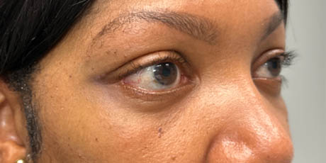 a_0015_pt after 59 lower bleph with facial fat grafting- right side.png