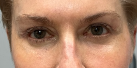patient 10 after quad bleph with CO2 laser, ptosis repair and temp brow lift– front 2.png