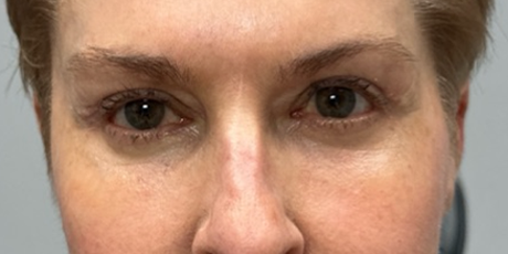 patient 10 after quad bleph with CO2 laser, ptosis repair and temp brow lift– front 2.png