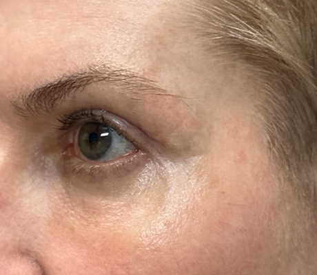 patient 10 after quad bleph with CO2 laser, ptosis repair and temp brow lift– left side.png