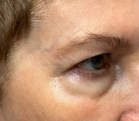 patient 10 after quad bleph with CO2 laser, ptosis repair and temp brow lift– right side.png