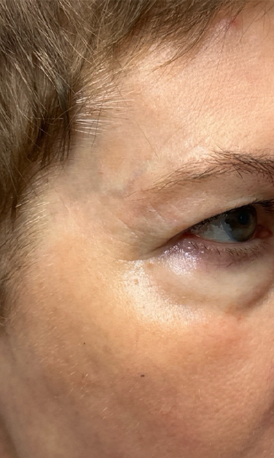 patient 10 after quad bleph with CO2 laser, ptosis repair and temp brow lift– right side.png