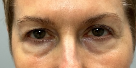 patient 10 before quad bleph with CO2 laser, ptosis repair and temp brow lift– front.png
