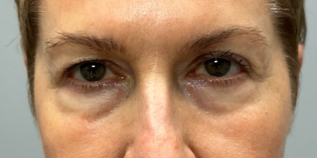 patient 10 before quad bleph with CO2 laser, ptosis repair and temp brow lift– front.png