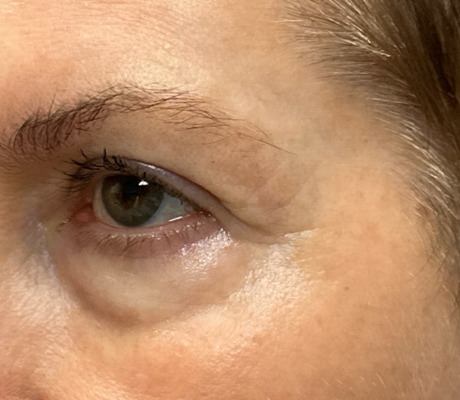patient 10 before quad bleph with CO2 laser, ptosis repair and temp brow lift– left side.png