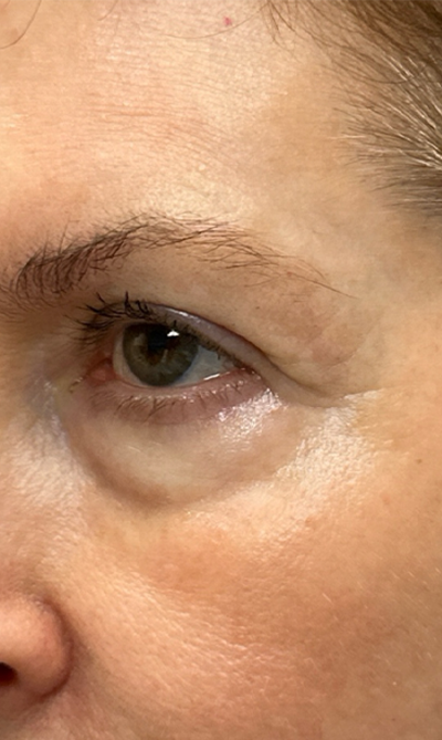 patient 10 before quad bleph with CO2 laser, ptosis repair and temp brow lift– left side.png
