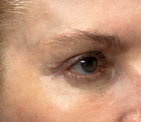 patient 10 before quad bleph with CO2 laser, ptosis repair and temp brow lift– right side.png