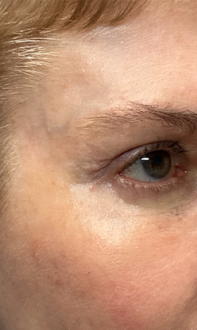 patient 10 before quad bleph with CO2 laser, ptosis repair and temp brow lift– right side.png