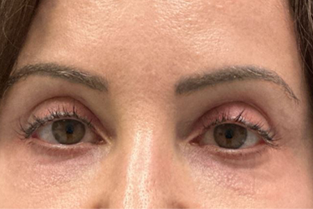 patient 10 before subbrow filler.JPG