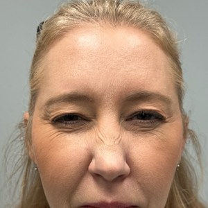 patient 11 after botox.png