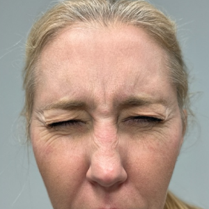 patient 11 before botox.png