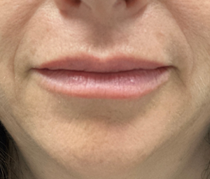 patient 12 after lip filler- front.png