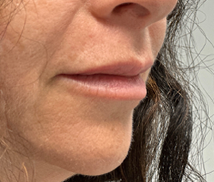 patient 12 after lip filler- side.png