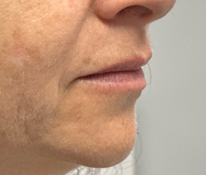 patient 12 before lip filler- side.png