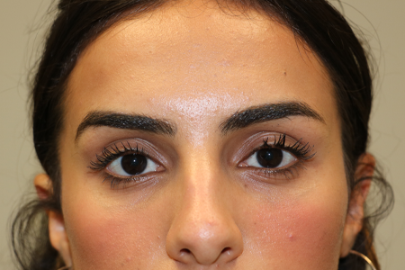 patient 17 before subbrow filler.JPG