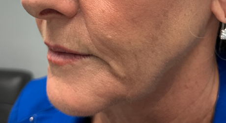 patient 19 after dissolving filler corner of mouth.png