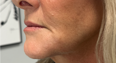 patient 19 before dissolving filler corner of mouth.png