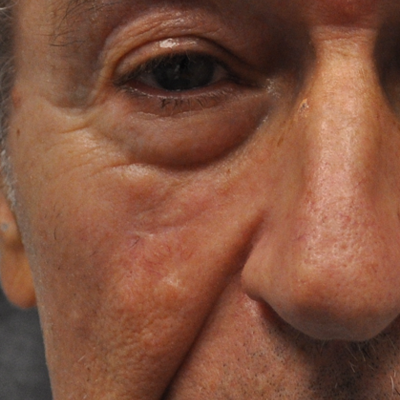 patient 2 after skin cancer repair.PNG