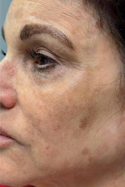 patient 4 after PRP with microneelding.PNG