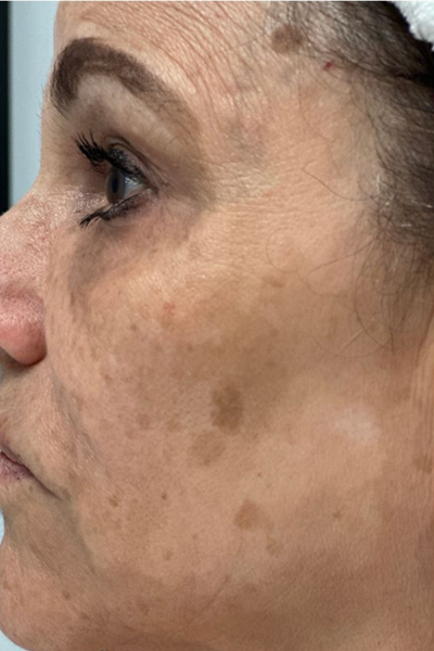 patient 4 before PRP with microneelding.PNG