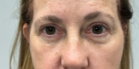 patient 60 before lower bleph with facial fat grafting and CO2 laser.png