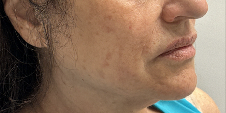 patient 7 before ultraclear.png