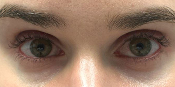 patient 8 after subbrow filler.JPG