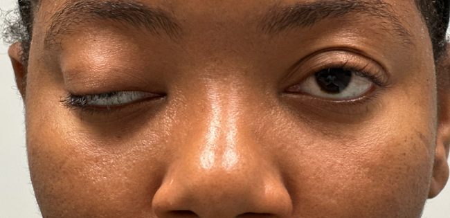 patient 8 before ptosis repair by frontalis sling- front.png