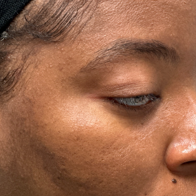 patient 8 before ptosis repair by frontalis sling.png