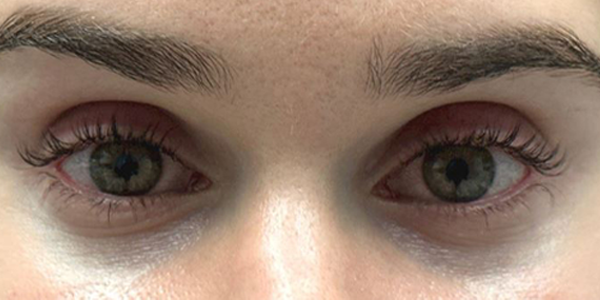 patient 8 before subbrow filler.JPG