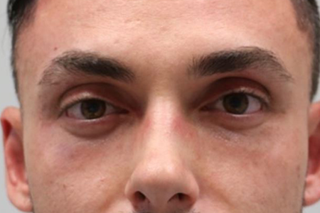 patient 9 before subbrow filler.JPG