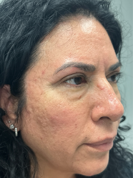 patient 91 after upper bleph with subbrow filler– right side.png
