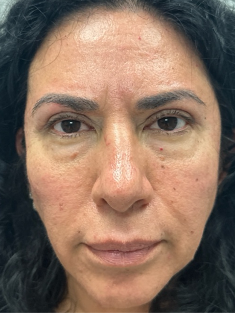 patient 91 after upper bleph with subbrow filler.png